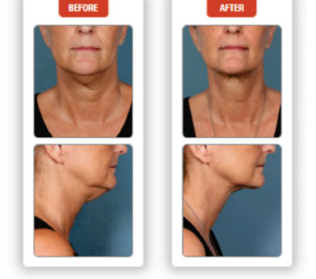 Image: Effects of Kybella: Unretouched photos of clinical trial patient (Sex: F, age: 55, BMI unchanged: 21.8 kg/m2) taken before and after 5 treatment sessions (Photo courtesy of Kythera Biopharmaceuticals).