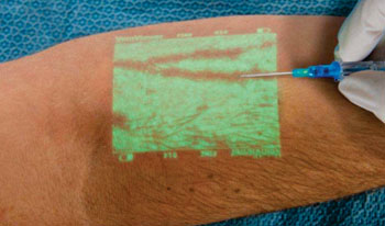 Image: The VeinViewer Vision2 projected vein image (Photo courtesy of Christie Medical Holdings).