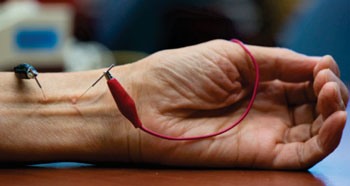 Image: Electroacupuncture using low-intensity electrical stimulation (Photo courtesy of Chris Nugent / UCI).
