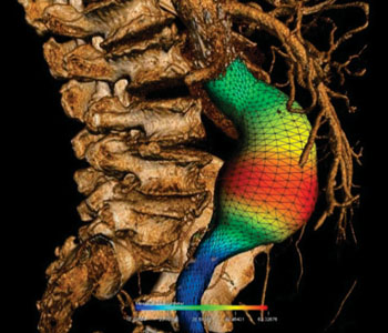 Image: 3-D reconstruction of an AAA with color representation (Photo courtesy of Claude Kauffmann/University of Montreal). Image: 3-D reconstruction of an AAA with color representation (Photo courtesy of Claude Kauffmann/University of Montreal).