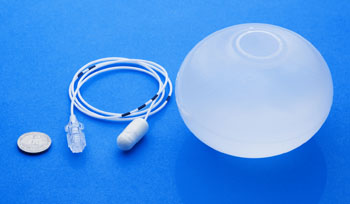 Image: The Elipse procedureless gastric balloon (Photo courtesy of Allurion Technologies).S