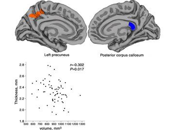 Image: Scatterplot showing the averaged cortical thickness in the left precuneus, and the volume of the posterior portion of corpus callosum in PTSD patients (Photo courtesy of RSNA). Image: Scatterplot showing the averaged cortical thickness in the left precuneus, and the volume of the posterior portion of corpus callosum in PTSD patients (Photo courtesy of RSNA).