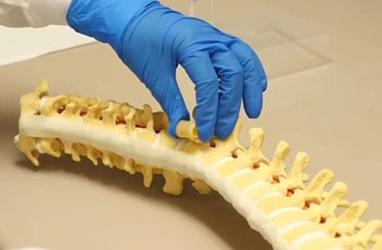 Image: Expanding polymer bone graft to replace excised spinal tissue (Photo courtesy of Dr. Lichin Lu).