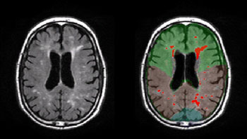 Image: The WMH in the brain of patient with Alzheimer’s disease (Photo courtesy of Adam Brickman/ Columbia University). Image: The WMH in the brain of patient with Alzheimer’s disease (Photo courtesy of Adam Brickman/ Columbia University).