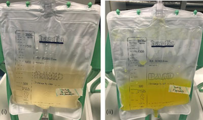 Image: A visual color change in urine collection bag in response to P. mirabilis infection (Photo courtesy of the University of Bath).