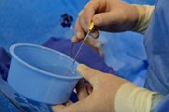 Image: Emory radiologists reduce Phantom Limb Pain (PLP) by applying a new non-invasive cryoablation procedure (Photo courtesy of Kevin Makowski, RBP). Image: Emory radiologists reduce Phantom Limb Pain (PLP) by applying a new non-invasive cryoablation procedure (Photo courtesy of Kevin Makowski, RBP).