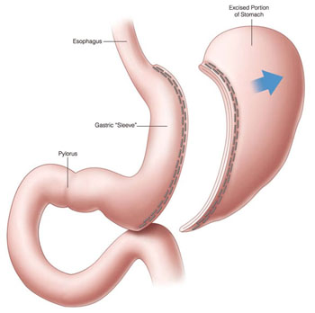 Image: According to a new study, sleeve gastrectomy improves LV systolic function and contributes to reverse LV remodeling in both genders (Photo courtesy of SPL).