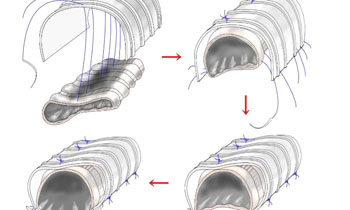 Image: The scheme of the external stent technique. Ringed PTFE graft, involving three to five rings, is used. The larger piece stabilizes the cartilage portion using three rows of stitches and a smaller one for the membrane portion (single row). The two graft pieces are overlapped by a few millimeters and not sewn to each other (Photo courtesy of the Sakakibara Heart Institute).