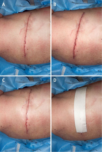 Image: A closed primary surgical wound without a dressing (a), with tissue adhesive (b), with an adherent and transparent dressing (c), and with an adherent and absorbent dressing (d) (Photo courtesy of BMJ).
