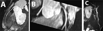Image: Three-dimensional steady-state free precession acquisition of cardiac structures acquired during 6.2 minutes of apnea with PV (Photo courtesy of CHUV).