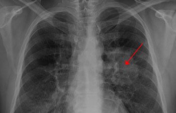 Image: The UK Lung cancer Screening trial found screening high-risk individuals can identify those individuals with early stage disease, and significantly increase their chance of long-term survival (Photo courtesy of Queen Mary University of London). Image: The UK Lung cancer Screening trial found screening high-risk individuals can identify those individuals with early stage disease, and significantly increase their chance of long-term survival (Photo courtesy of Queen Mary University of London).