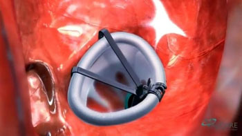 Image: The Amend mitral valve repair annuloplasty ring (Photo courtesy of Valcare Medical).