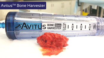 Image: The Avitus bone harvester (Photo courtesy of Avitus Orthopaedics).
