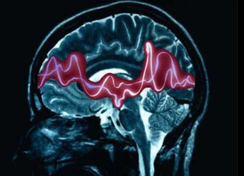 Image: An illustration of epilepsy seizure disorder (Photo courtesy of SlideShare).