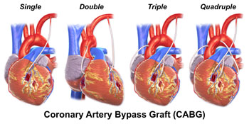 Image: Four different CABG surgical options (Photo courtesy of Labroots).