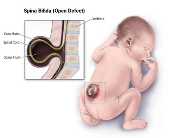 Image: Spina Bifida open defect (Photo courtesy of Wikimedia).