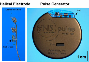 Image: The Cyberonics VNS system used in the study (Photo courtesy of AMC).