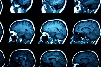 Image: Brain scans. Autism, ADHD and OCD have common symptoms and are linked by some of the same genes, but have been studied as separate disorders (Photo courtesy of Fotolia).