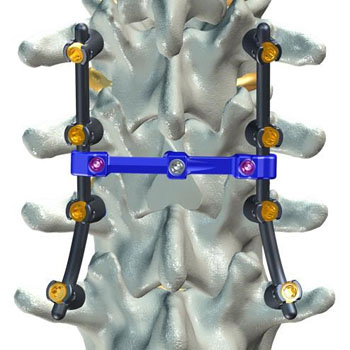Image: The Connect-L Transverse Connector (Photo courtesy of DeGen Medical).