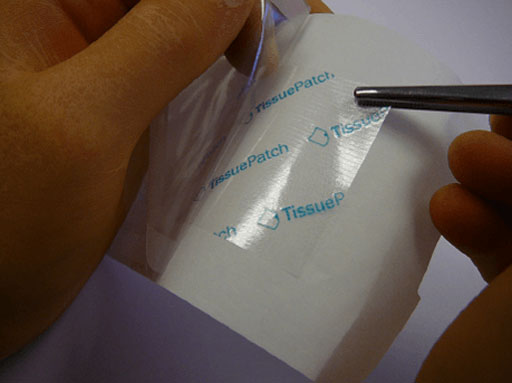 Image: The TissuePatch helps to seal air leaks in lung surgery (Photo courtesy of TissueMed).