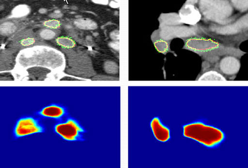 Image: Lymph nodes segmented by BNF (green), with corresponding BNF probability maps (Photo courtesy of Ronald Summers/NIH). Image: Lymph nodes segmented by BNF (green), with corresponding BNF probability maps (Photo courtesy of Ronald Summers/NIH).