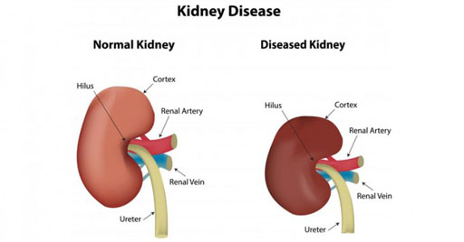 Image: New research shows en bloc ligation of the diseased kidney is safe (Photo courtesy of Alamy).