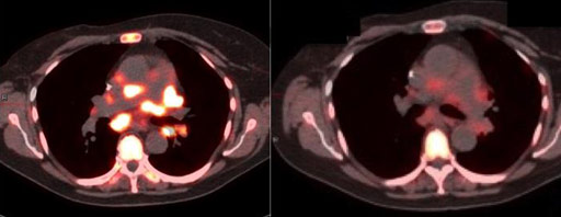 Image: The image on the left is from before therapy, and the image on the right from three days after treatment (Photo courtesy of Penn Medicine).