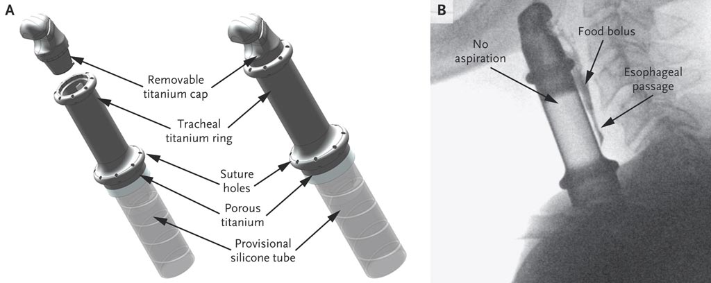 Image: The layout and composition of the ENTegral artificial larynx (Photo courtesy of INSERM).