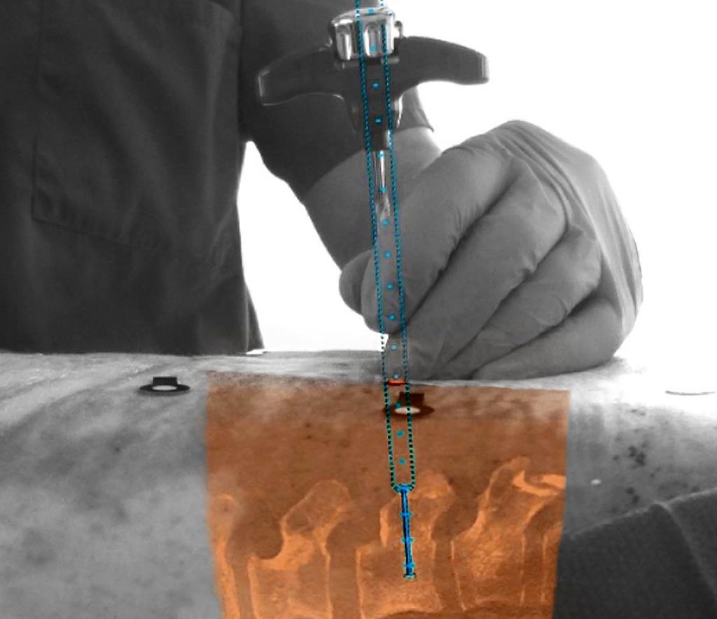 Image: The new augmented-reality surgical navigation technology for spinal surgery (Photo courtesy of Royal Philips).
