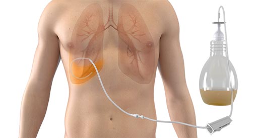 Image: The PleurX catheter system for draining pleural effusions (Photo courtesy of BD).