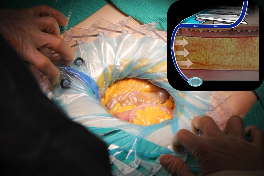 Image: The CleanCision wound retraction and protection system (Photo courtesy of Prescient Surgical).
