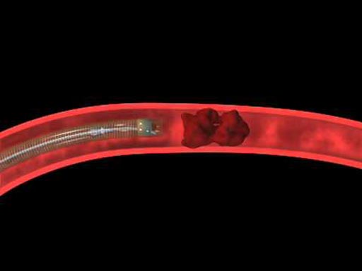 Image: The Penumbra direct aspiration catheter (Photo courtesy of Penumbra).