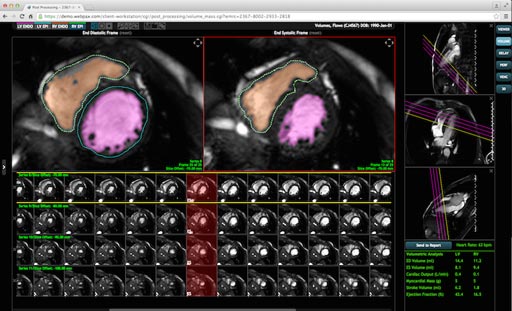 Image: The latest version of the Precession advanced CMR solution (Photo courtesy of HeartIT).