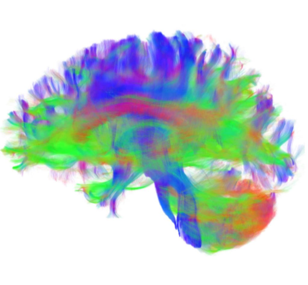 Image: A rendering of the structural brain connections in a 21-year-old male patient (Photo courtesy of PENN Medicine).