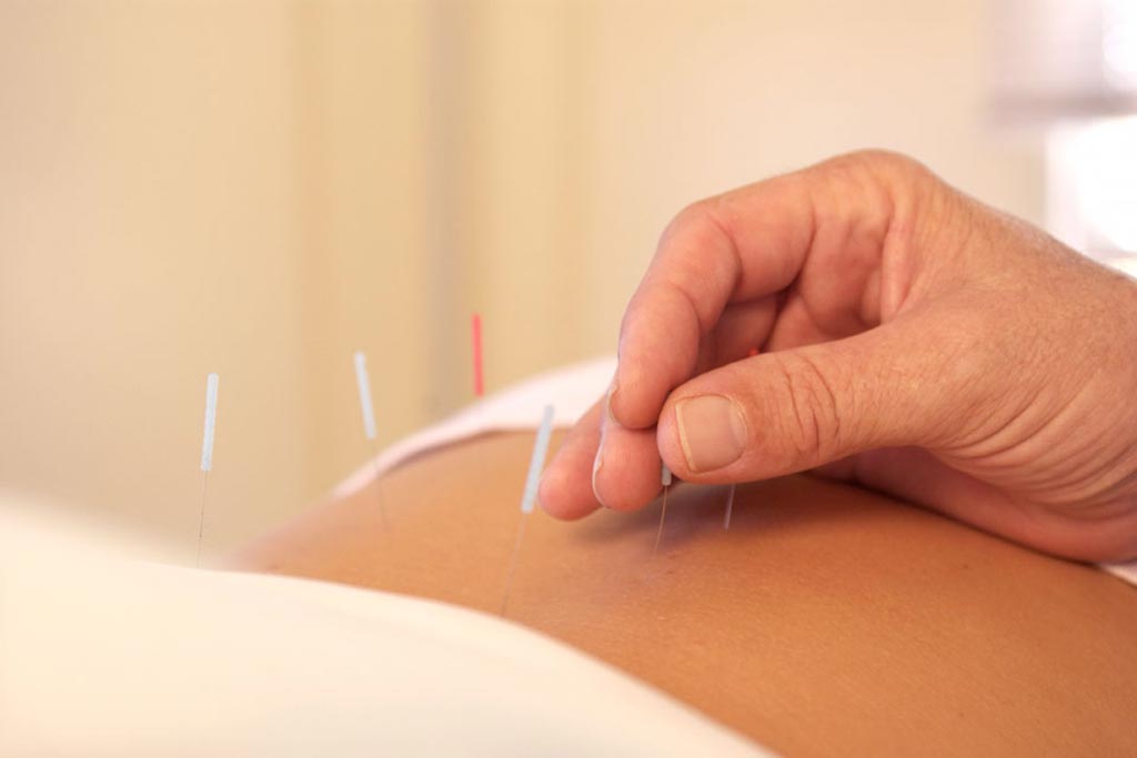 Image: Research shows acupuncture is as good as drugs for treating certain pains (Photo courtesy of Alamy).