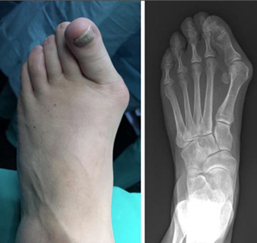 Image: The clinical and radiographic appearance of a bunion (Photo courtesy of AAOS).