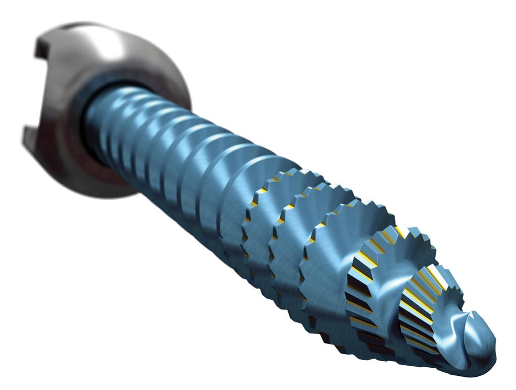 Image: The Serrato pedicle screw (Photo courtesy of Stryker).
