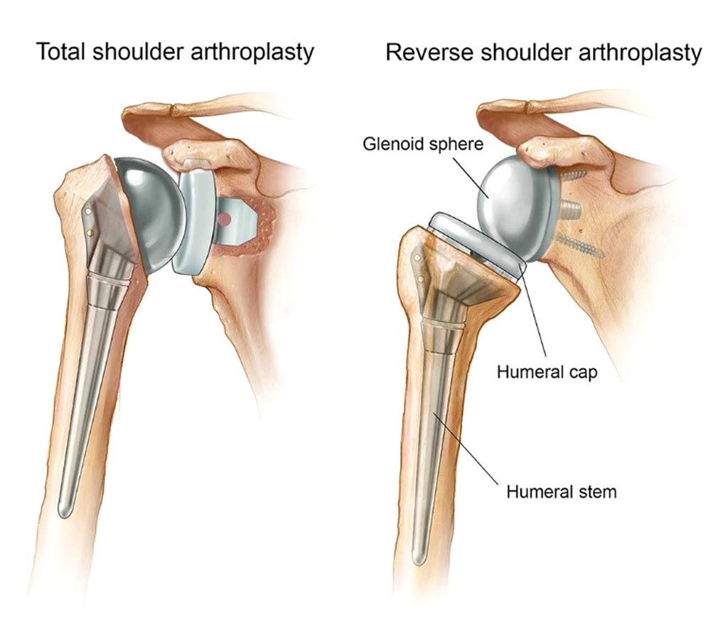 Image: According to a new study, reverse total shoulder arthroplasty is a good solution for irreparable rotator cuff tears (Photo courtesy of the Mayo Clinic).