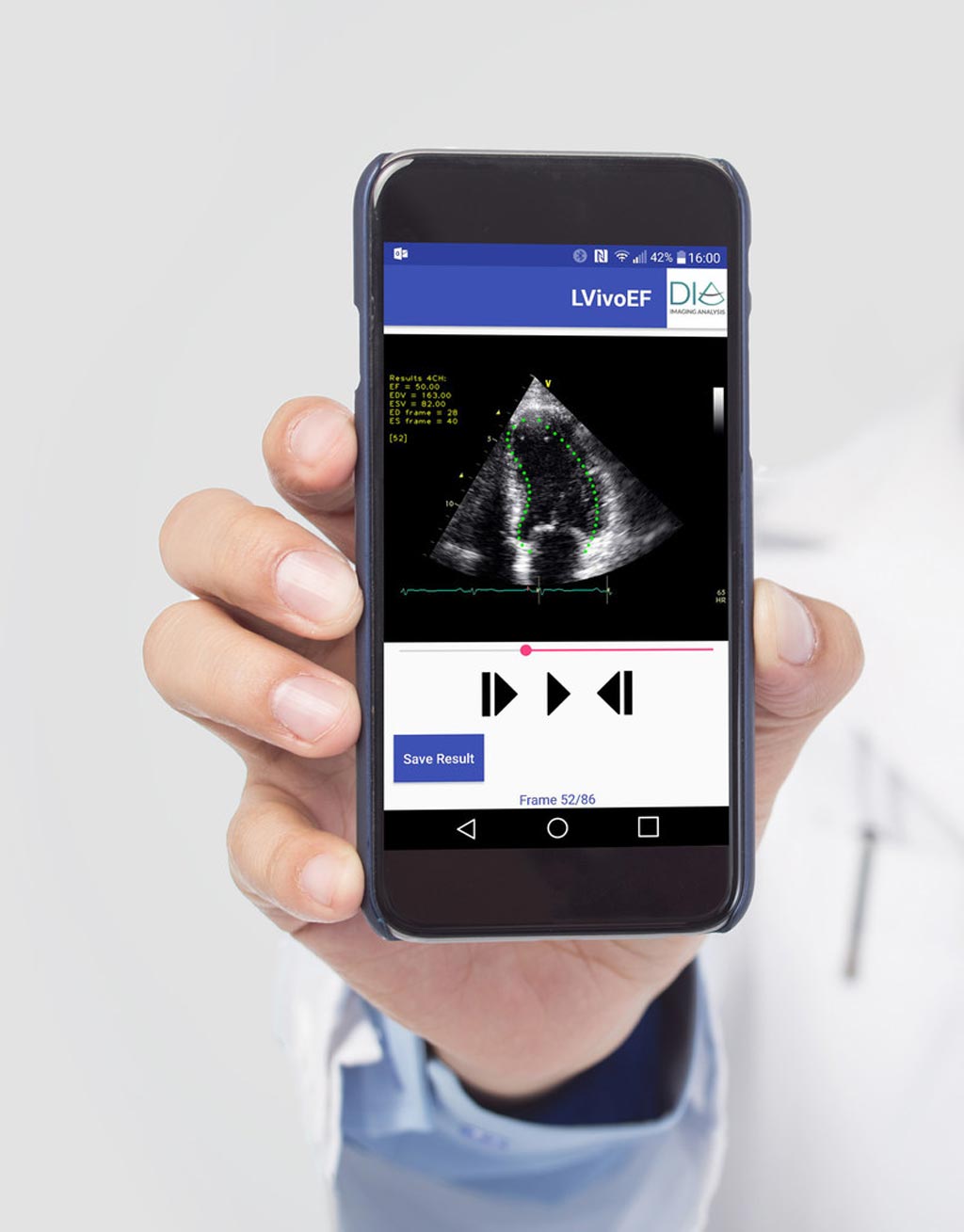 Image: Automated tools for ultrasound analysis on mobile devices (Photo courtesy of DiA). Image: Automated tools for ultrasound analysis on mobile devices (Photo courtesy of DiA).