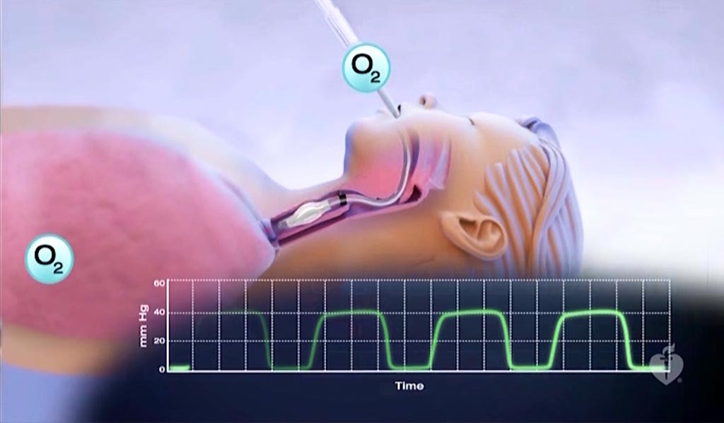 Image: A new study suggests capnography monitoring can reduce harm during gastrointestinal endoscopic procedures (Photo courtesy of Pisanieprac).
