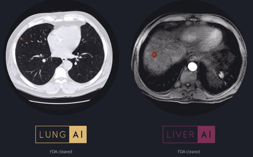 Image: When Oncology AI is used in combination with the company’s web-based offering, clinicians can measure and track tumors or potential cancers and apply radiological standards (Photo courtesy of Arterys).