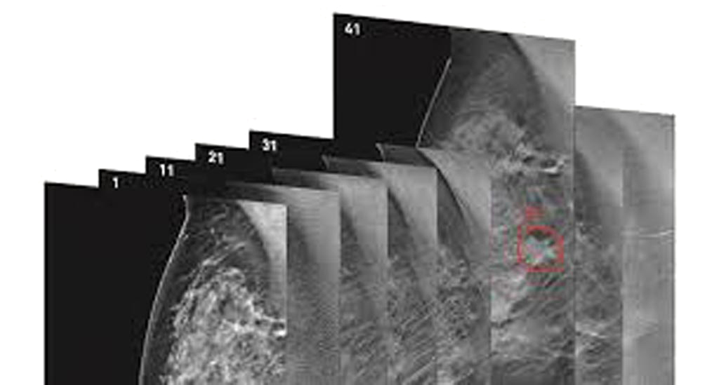 Image: The software engine named Transpara DBT is intended to assist radiologists in reading digital breast tomosynthesis and mammography exams (Photo courtesy of ScreenPoint Medical).