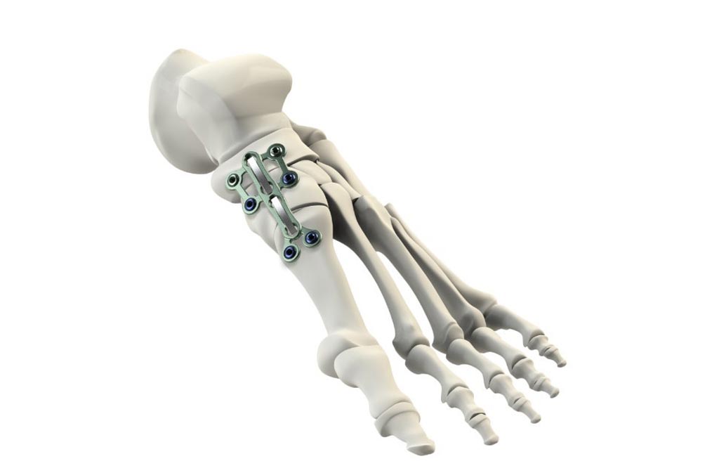 Image: The plate and nitinol clip fixation system is designed to stabilize the ankle (Photo courtesy of CrossRoads).