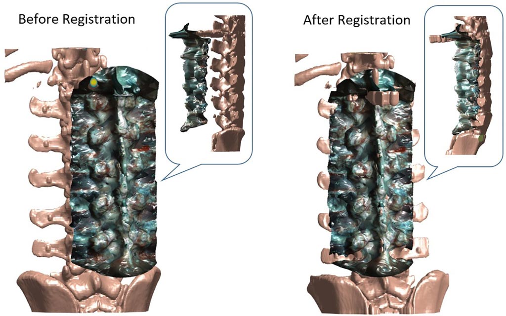 Image: Computed tomography is transformed to match surfaces to iSV by pairing tracking system coordinates (Photo courtesy of Dartmouth College).