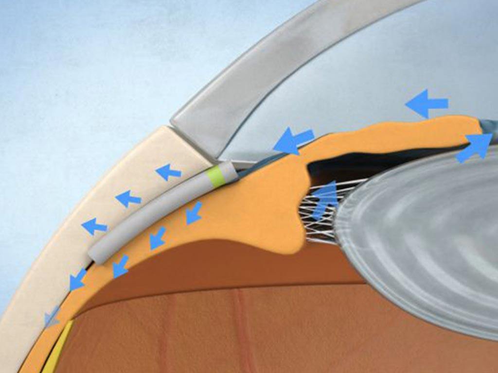 Image: A novel implant helps glaucoma patients by improving aqueous humor outflow (Photo courtesy of iSTAR Medical).