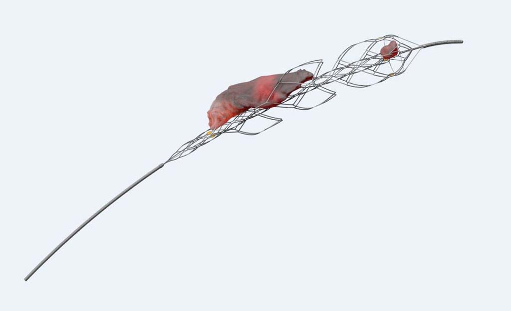 Image: The upgraded EmboTrap II stent retriever (Photo courtesy of Cerenovus).