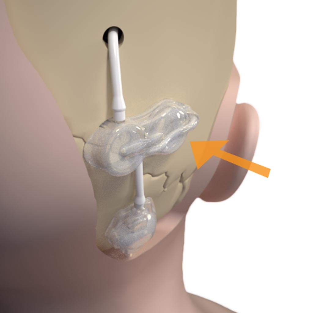 Image: The new ventricular catheter and flusher system is designed to restore CSF flow (Photo courtesy of Anuncia).