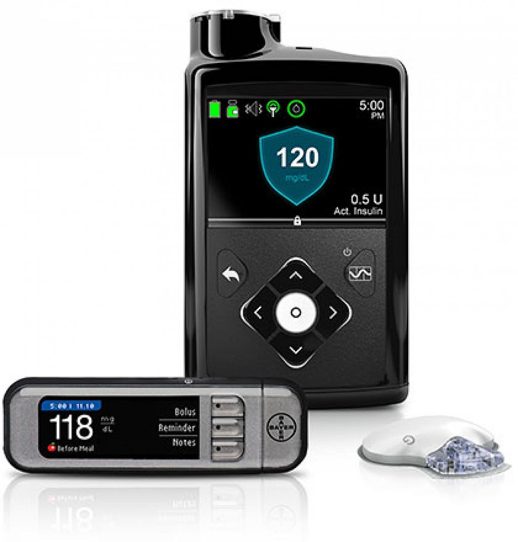 Image: The MiniMed 670G hybrid closed-loop system (Photo courtesy of Medtronic).