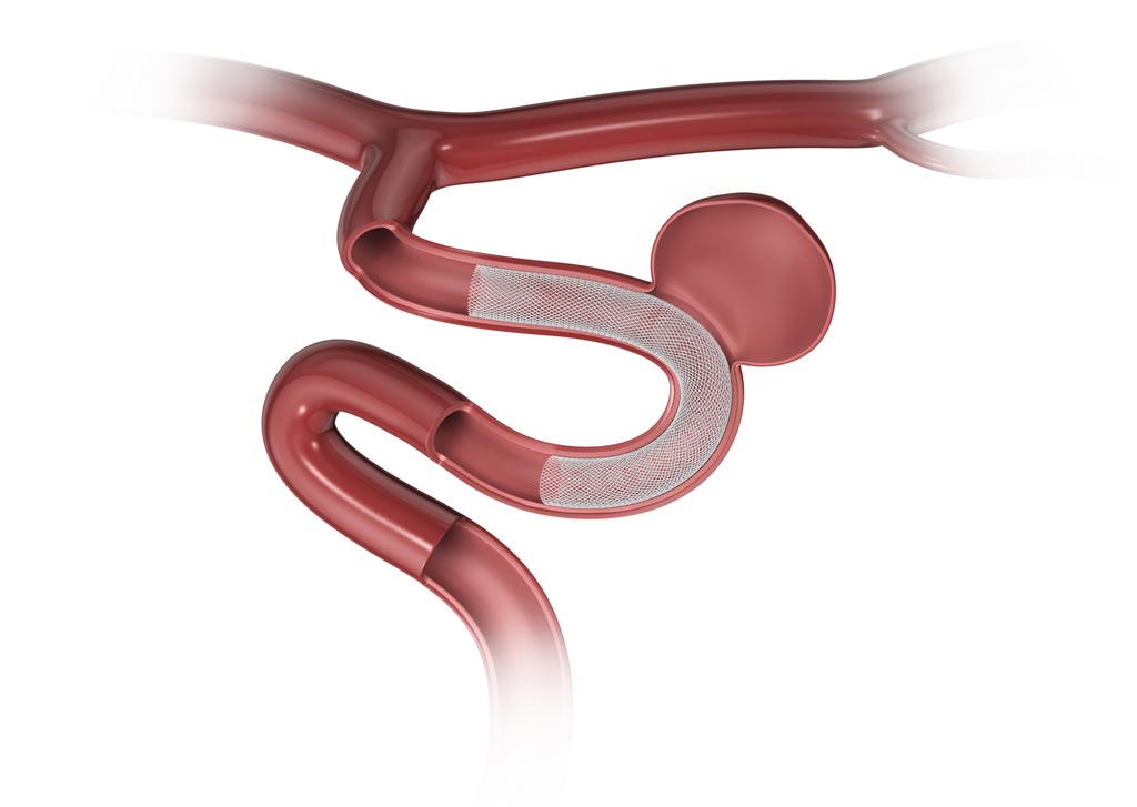 Image: The Surpass Streamline Flow Diverter in proximity to an aneurysm (Photo courtesy of Stryker).