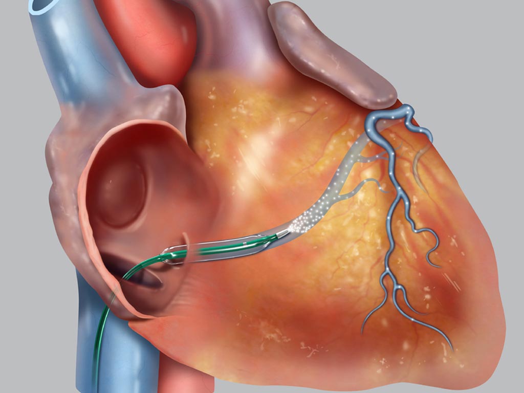Image: A novel catheter infuses drugs into the heart (Photo courtesy of Cook Regentec).